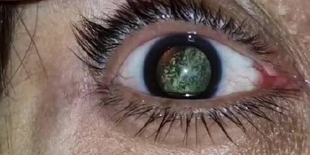 眼部「小行星透明症」是什么疾病？